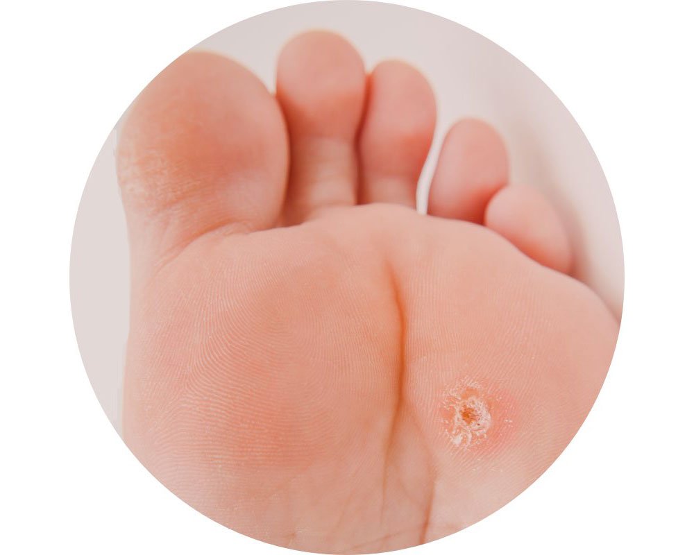 Wart removal