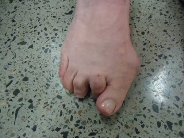 Example of hammertoe