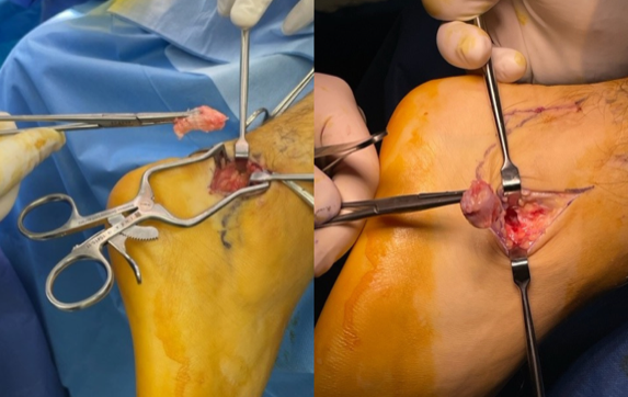 Posterior “ankle pain” (intra-operative images)